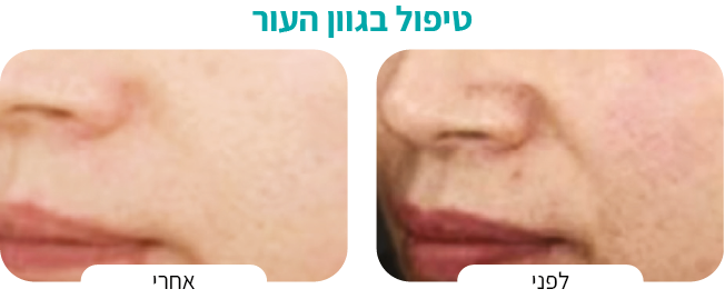 טיפול בגוון העורAsset 1