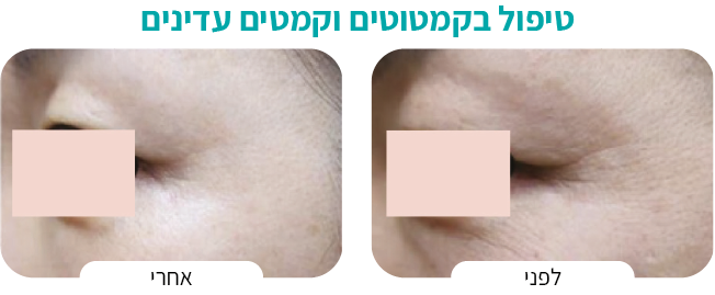 טיפול בגוון העורAsset 2
